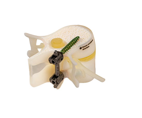 BoneMatrix  DAP 3d printed spine