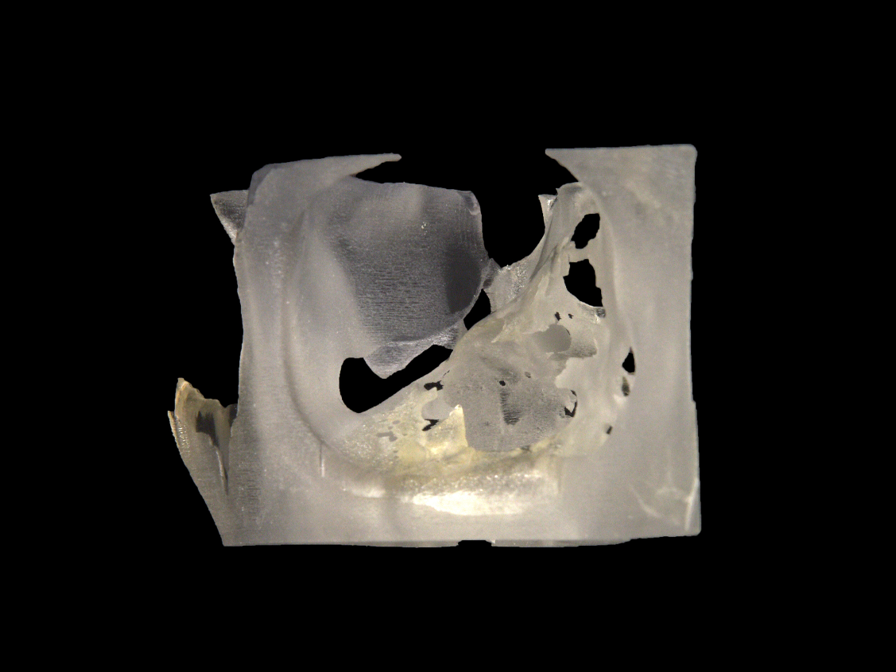 An anatomically accurate, patient-specific 3D printed surgical guide
and 3D model of the right orbit.