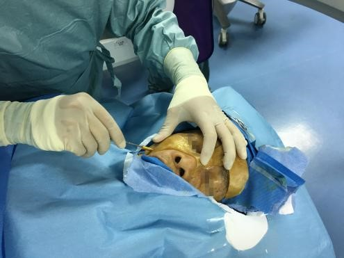 The 3D printed facial guide plate made using ULTEM™ 1010 resin