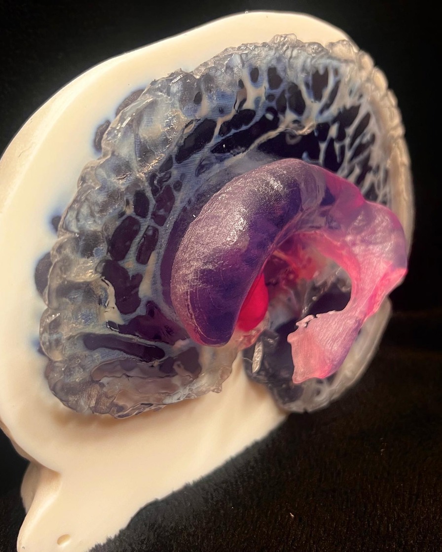 3D Print head model with a rare brain tumor