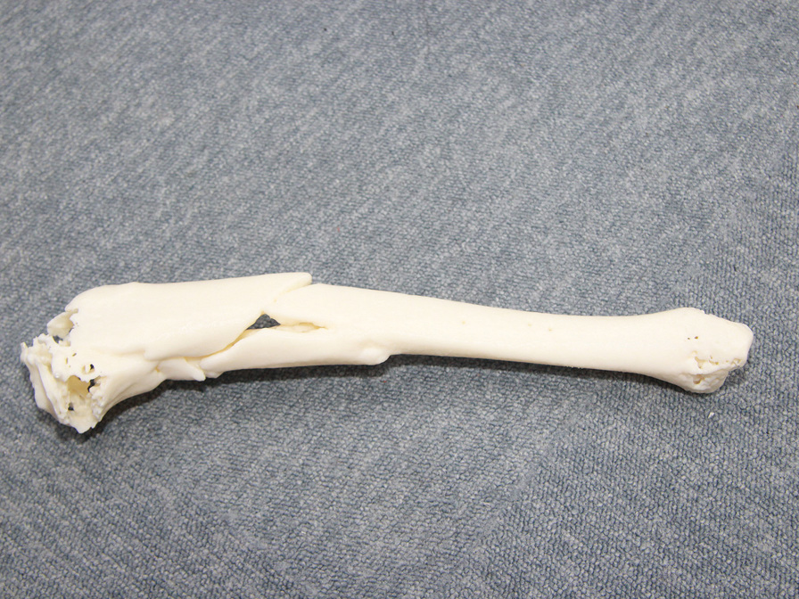 Prince of Wales uses 3D printing in cases ranging from corrective osteotomy (re-alignment of bone from deformity) to complex bone fractures from car accidents, like the above.