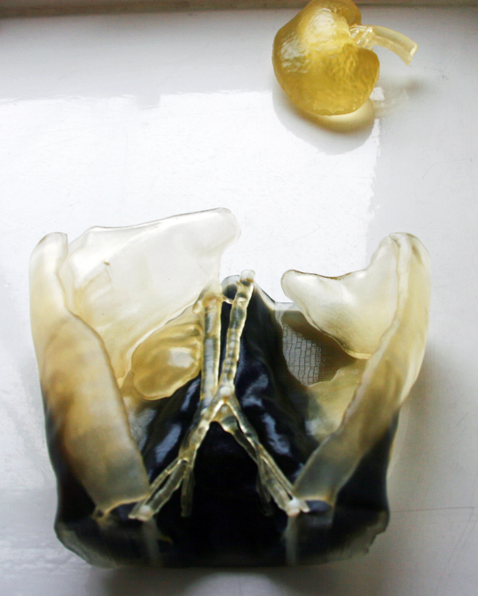 3D printed model of Dexter’s abdomen next to a 3D model of his
father’s kidney, enabling surgeons to determine transplant feasibility.