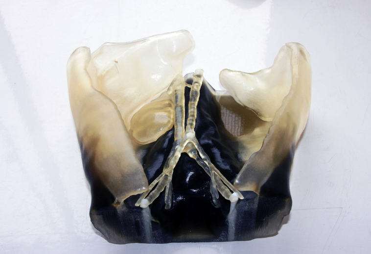 3D printed model of Dexter’s abdomen next to a 3D model of his father’s kidney, enabling surgeons to determine transplant feasibility