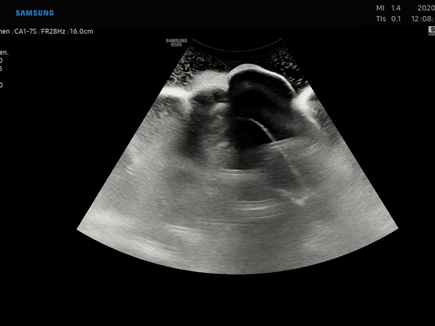 Ultrasound catheter.