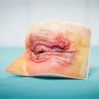 eye-surgery-tumbnail