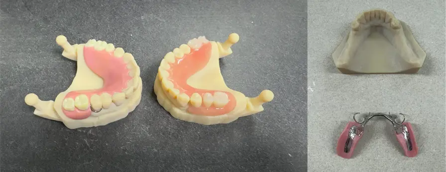partial-dentures-and-rpd-with-metal