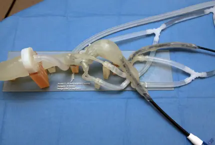 abdominal-aortic-aneurysm