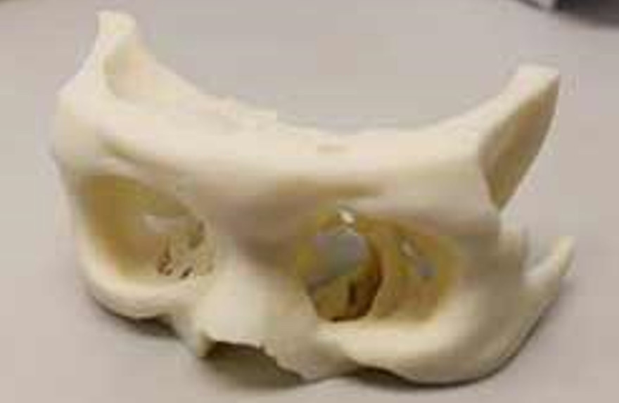 3D printed prototypes used for eye orbital implant surgeries help improve accuracy and shorten the operation.
