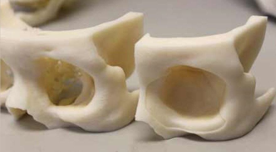 3D printing helps visualize a patient's missing orbital floor (left) versus original shape before impact (right)