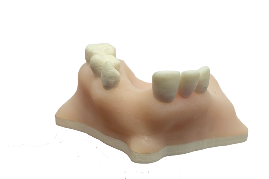 3D printed denture by FuseTec