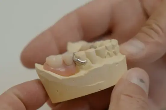 Natural looking 3D Printed partial TrueDent denture