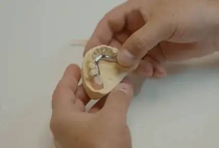 Stratasys TrueDent 3D Printed partial denture with metal framework