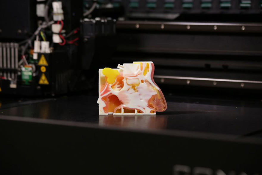 3D printed patient-specific models for surgical planning.